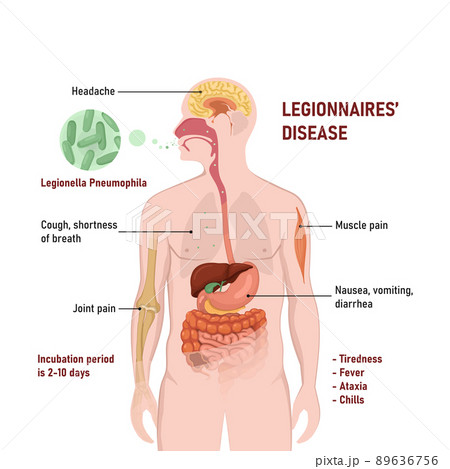 Legionnaires disease or legionellosis or Legion fever. Signs and symptoms is a form of atypical pneumonia. Legionnaires disease or legionellosis or Legion fever. Signs and symptoms is a form of atypical pneumonia. 89636756