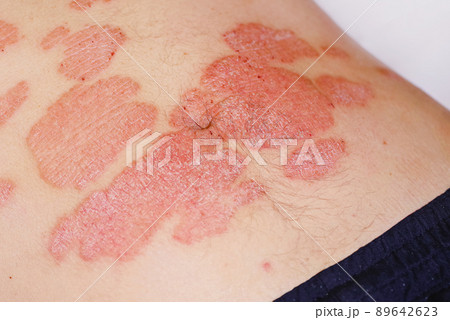 Large red inflamed scaly rash on the stomach. Acute psoriasis on the stomach in a man, severe redness on the skin, an autoimmune incurable dermatological skin disease. Red redness, spots on the skin. 89642623