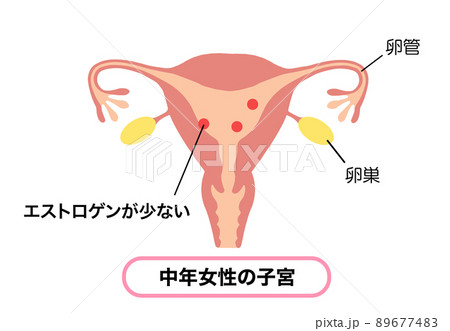 エストロゲンが少ない、中年女性の子宮イラスト 89677483