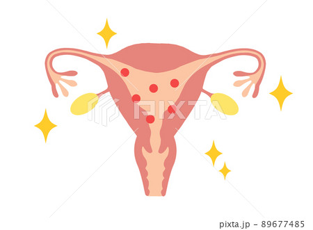 エストロゲンが多い、若い女性の子宮イラスト 89677485