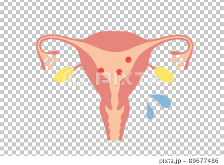 雌激素低的中年婦女子宮示意圖 雌激素低的中年婦女子宮示意圖 89677486