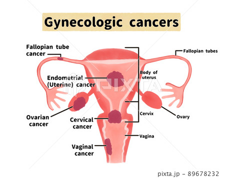婦人科がんの種類の図解イラスト　英語 89678232