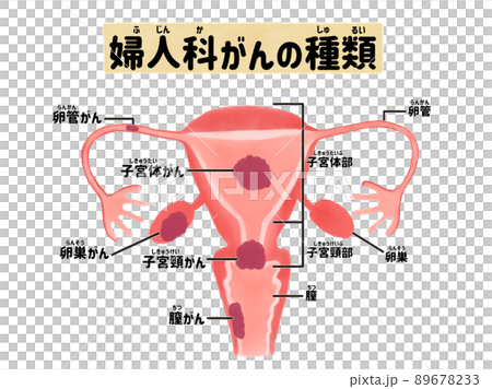 婦人科がんの種類の図解イラスト 日本語のイラスト素材 6733