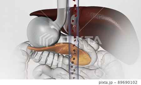 Diabetes is a metabolic disorder caused by high levels of blood sugar. 89690102