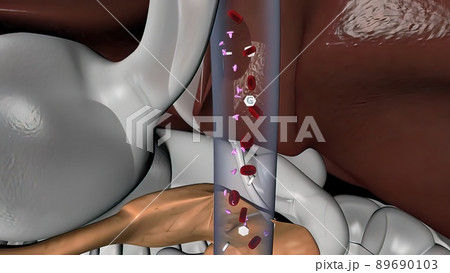 Diabetes is a metabolic disorder caused by high levels of blood sugar. 89690103