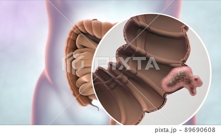 Magnifying glass of intestinal cancer. Tumor formation and growth 89690608