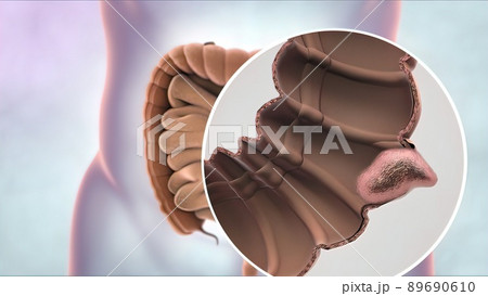 Magnifying glass of intestinal cancer. Tumor formation and growth 89690610