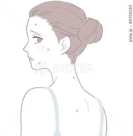 ニキビに悩む女性 89709265