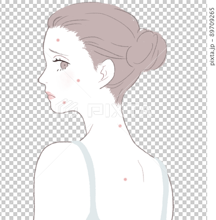 ニキビに悩む女性 89709265