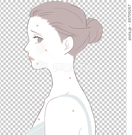 Women suffering from acne Women suffering from acne 89709267