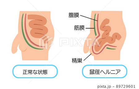 鼠径ヘルニア　脱腸のイラスト 89729601