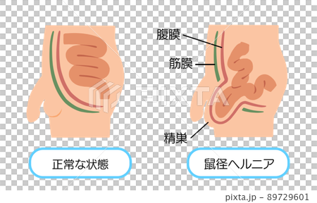 鼠径ヘルニア　脱腸のイラスト 89729601