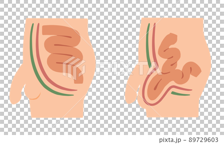 腹股溝疝的插圖 89729603