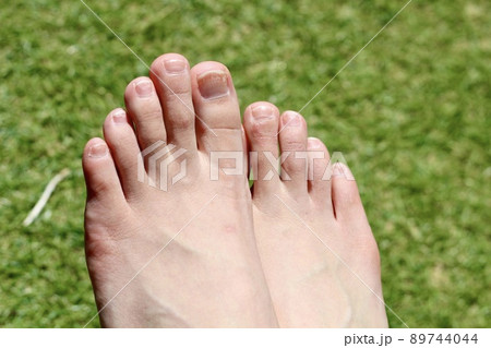 芝生の上、女性の素足。しもやけ、荒れた爪のあと 芝生の上、女性の素足。しもやけ、荒れた爪のあと 89744044