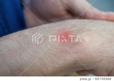 Male hand with the wound from snake bite or snakebite. Bite marks with blood drops and red skin. Closeup, selective focus Male hand with the wound from snake bite or snakebite. Bite marks with blood drops and red skin. Closeup, selective focus 89748986