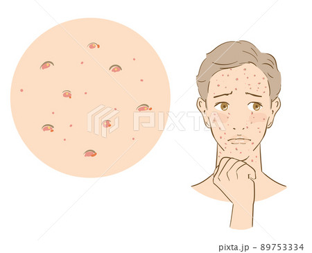 ニキビに悩む爽やかな男性 ニキビに悩む爽やかな男性 89753334