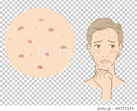 ニキビに悩む爽やかな男性 ニキビに悩む爽やかな男性 89753334