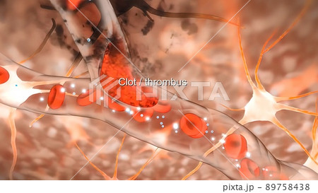 Brain Hemorrhagic Stroke Due To Aneurysm Rupture. 89758438