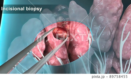 Breast cancer Girl with breast pathology. . Illustration and close-up of female human structure. Breast cancer Girl with breast pathology. . Illustration and close-up of female human structure. 89758455