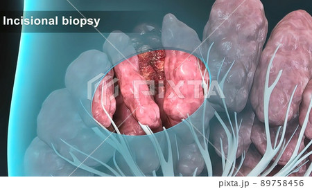 Breast cancer Girl with breast pathology. . Illustration and close-up of female human structure. Breast cancer Girl with breast pathology. . Illustration and close-up of female human structure. 89758456