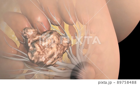 Breast Cancer, Breast anatomy, Growing tumor. Cancer that forms in the cells of the breasts. 89758488