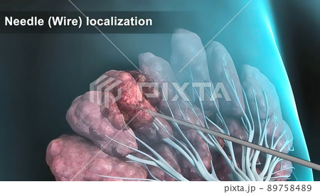 Breast cancer Girl with breast pathology. . Illustration and close-up of female human structure. Breast cancer Girl with breast pathology. . Illustration and close-up of female human structure. 89758489