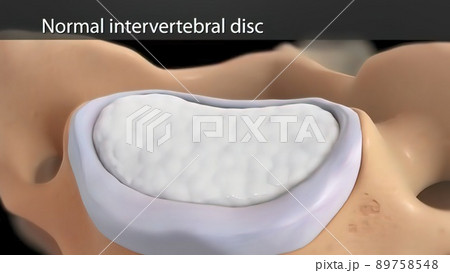 Top view of normal intervertebral disc Top view of normal intervertebral disc 89758548