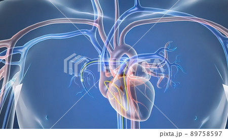 Opening the occluded artery by inserting a stent Opening the occluded artery by inserting a stent 89758597