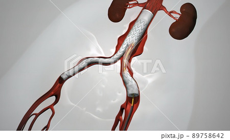 balloon angioplasty procedure with stent in vein 89758642