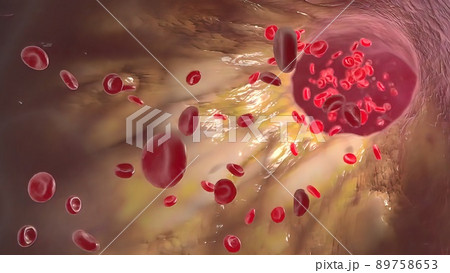 Clogging of the arteries with plaque Clogging of the arteries with plaque 89758653