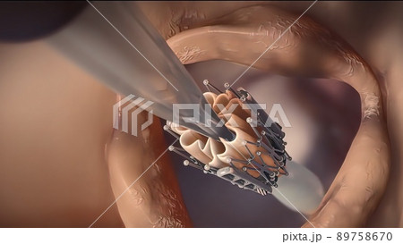 An artificial heart valve is inserted instead of a dysfunctional heart valve. 89758670