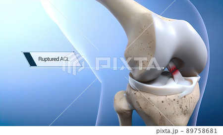 Anterior Cruciate Ligament (ACL) Injury or Tear 89758681