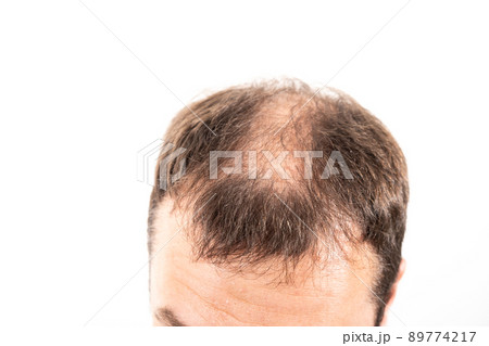 Close-up balding head of a young man on a white isolated background. 89774217