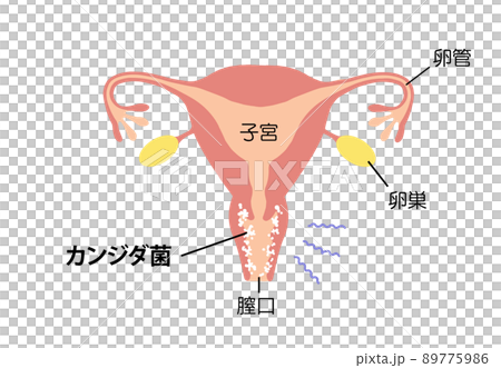 生病子宮的陰道炎插圖 生病子宮的陰道炎插圖 89775986