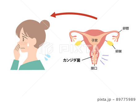膣炎　病気になった子宮のイラスト 89775989