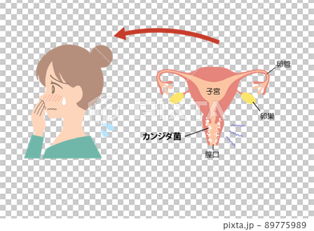 膣炎　病気になった子宮のイラスト 89775989