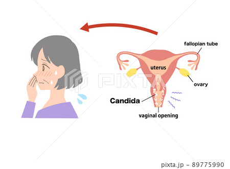 膣炎　病気になった子宮のイラスト 89775990