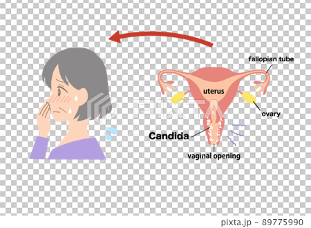 Vaginitis Illustration of a sick uterus 89775990