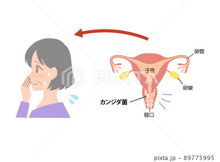 膣炎　病気になった子宮のイラスト 89775995