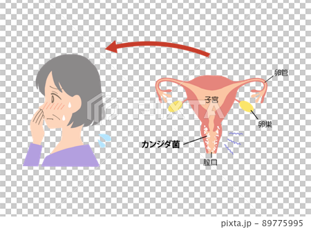 膣炎　病気になった子宮のイラスト 89775995