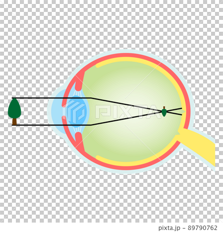 高度近視焦點眼球橫斷面圖 89790762