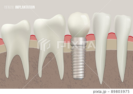 Dental implantation vector illustration. Sound teeth and dental implant on medical illustration. Dental implantation vector illustration. Sound teeth and dental implant on medical illustration. 89803975