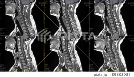 set of 6 sagittal MRI scans of neck area of caucasian 34 years old male with bilateral paramedial extrusion of the C6-C7 segment with radiculopathy set of 6 sagittal MRI scans of neck area of caucasian 34 years old male with bilateral paramedial extrusion of the C6-C7 segment with radiculopathy 89832082