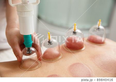 Vacuum massage. Vacuum cups of medical cupping therapy on woman back, close up, chinese medicine. 89840416