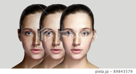 Step by step concept of healing and removing freckles. Closeup portrait of beautiful brunette woman after laser treatment on face looking at camera. indoor studio shot, isolated on gray background. 89843579
