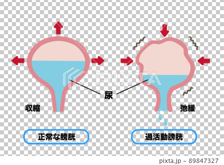 尿失禁膀胱機制說明 89847327