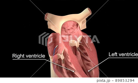 Catheter ablation 3D Medical illustration Catheter ablation 3D Medical illustration 89853294