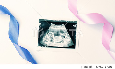 Ultrasound photo pregnancy baby. Blue, pink ribbon with ultrasound pregnancy picture on white background. Concept maternity, pregnancy, childbirth. 89873780