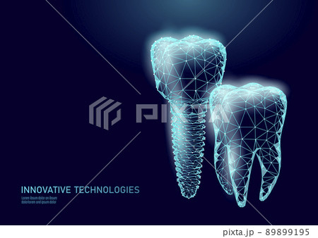 Molar tooth dental implant 3d low poly geometric model. Dentistry innovation future technology titan metal thread. Medical healthy science blue polygonal point line vector illustration Molar tooth dental implant 3d low poly geometric model. Dentistry innovation future technology titan metal thread. Medical healthy science blue polygonal point line vector illustration 89899195