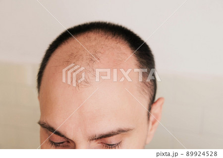 Young caucasian man looking at mirror worried about balding. 89924528